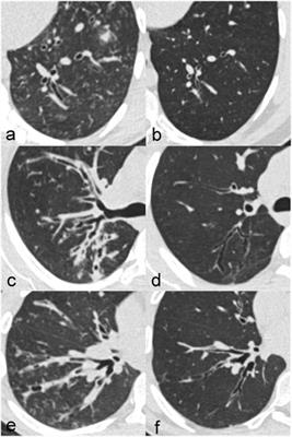 Qualitative and quantitative evaluation of computed tomography changes in adults with cystic fibrosis treated with elexacaftor-tezacaftor-ivacaftor: a retrospective observational study